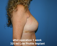 plastic-surgery-breast-augmentation